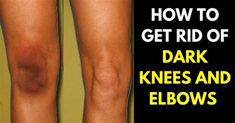 How To Lighten Knees And Elbows 10 Home Remedies