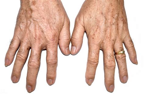 What Can I Do About Brown Aging Spots On My Hands