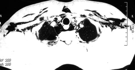 Ct Chest Showing Extensive Surgical Emphysema And Pneumomediastinum