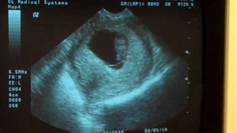 A Heartbeat 8 Weeks 1 Day Ultrasound Youtube