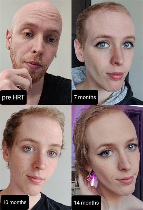 Hair Growth Over 14 Months From Bald Mtf Rtranstimelines