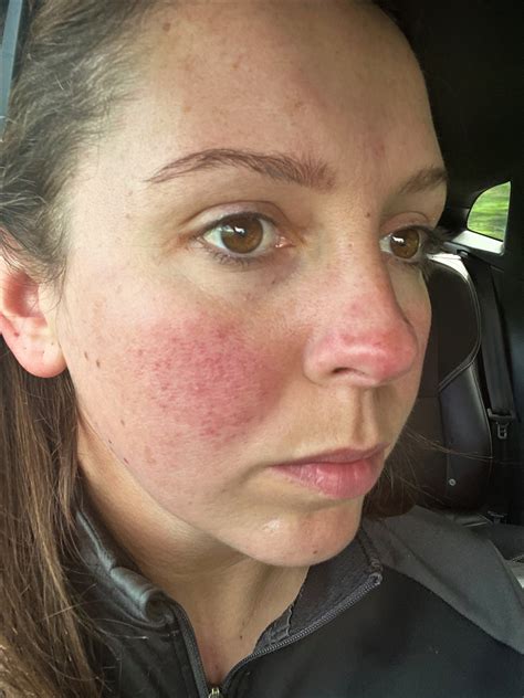 Red Face During Pregnancy Made Mum Cry Until She Found The Cure