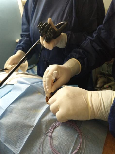 Percutaneous Endoscopic Gastrostomy Peg A Practical