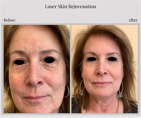 Laser Skin Rejuvenation Before And After Lawrence Township Nj Sleep