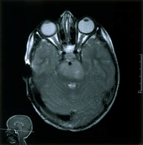 Mri Scan Brain Cancer Glioma Brain Stem Wellcome Collection