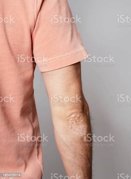Man With Psoriasis On His Elbows Stock Photo Download Image Now
