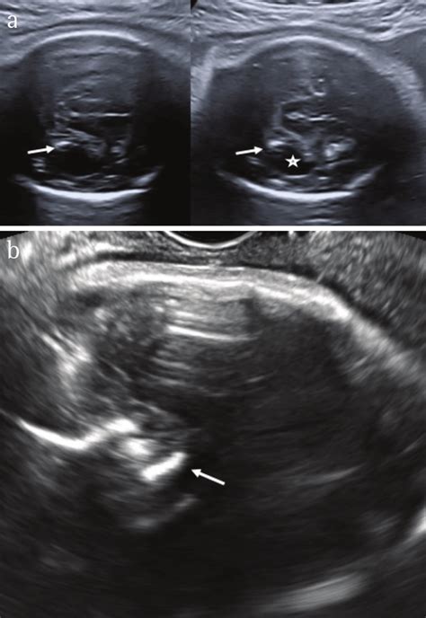Prenatal Ultrasound Showing Calcifications Arrows Ventricular