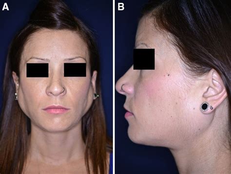 Parotid Gland Swelling Eating Disorders