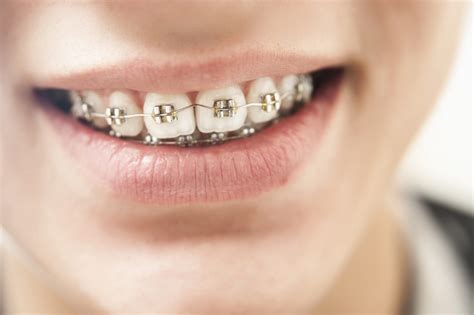 Different Kinds Of Braces How They Work