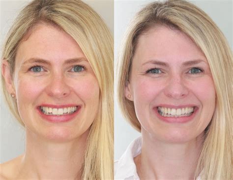 Invisalign And Braces For Gaps Before And After Results