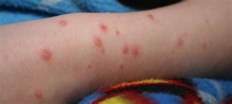 Maybe you would like to learn more about one of these? Skin Allergies In Babies And Kids, Skin Rashes in Kids ...