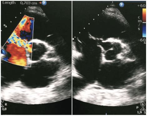 Defeito De Gerbode Aspectos Ecocardiográficos Blog Ecope