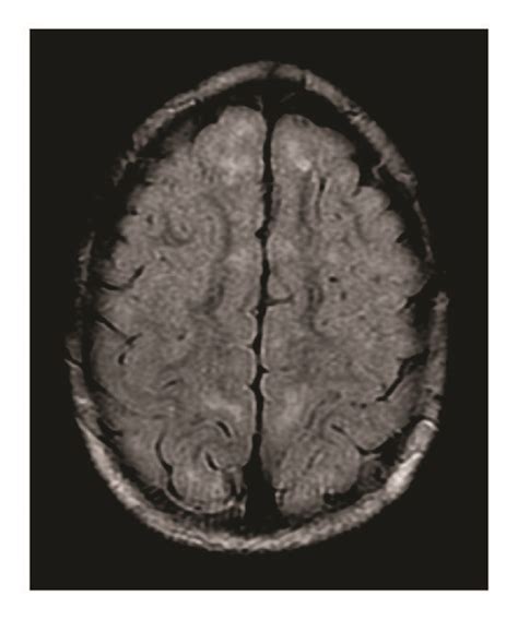 Axial T2 Flair Mri Image Demonstrating Subcortical White Matter