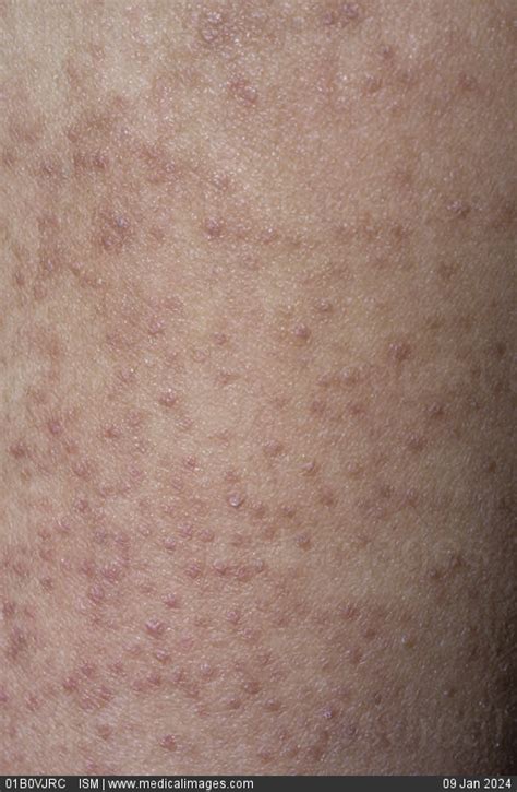 Stock Image Keratosis Pilaris On The Arm Of A Male Patient Close Up