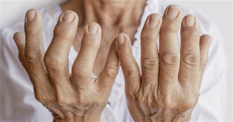 Artritis Handen