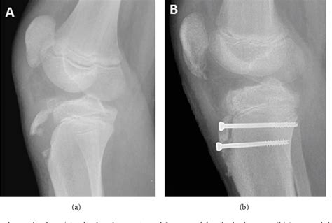 Tibial Tubercle Fracture