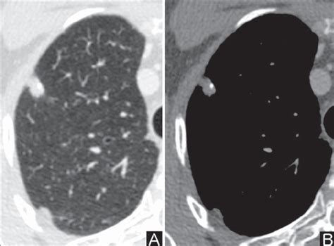 Malignant Calcification Pattern Chest Ct Lung Window A And