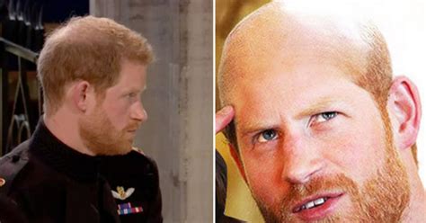 Is Prince Harry Going Bald Hair Loss Is Spreading Expert Confirms