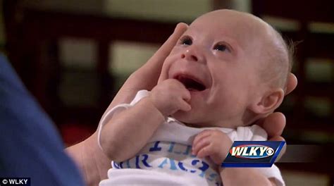 Seven Month Old Kentucky Boy Who Weighs Three Pounds Born With Rare Form Of Dwarfism Daily