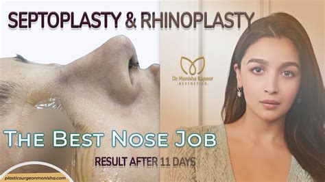Best Nose Job Best Rhinoplasty And Septoplasty Success Story With Dr Monisha Kapoor Delhi