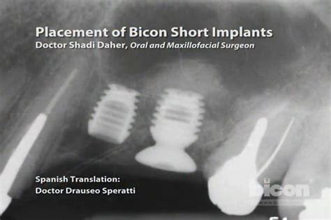 Placement Of Bicon Short Implants Bicon Dental Implants