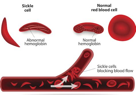 How Does Sickle Cell Anemia Affect Pregnancy Your Pregnancy Matters