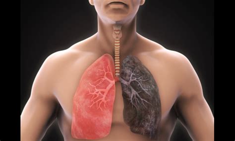 Cigarette Smoker Lungs