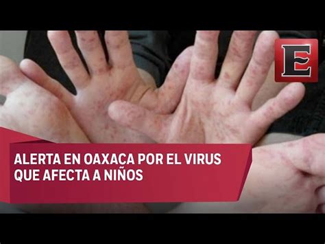 Virus De Coxsackie ¿cuáles Son Los Síntomas Y Cómo Se Contagia