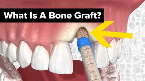 Dental Bone Grafts Explained Youtube