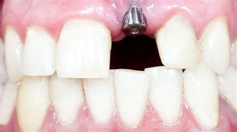 Discover How Dental Implants Improve The Look Of The Mouth Cosmetic Town