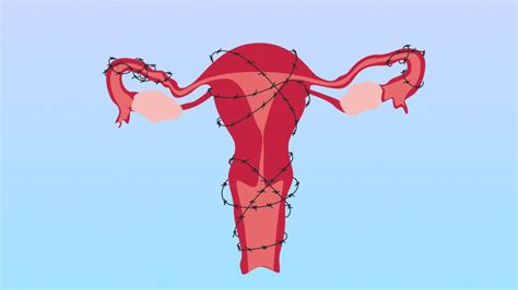 The Four Different Stages Of Endometriosis Explained