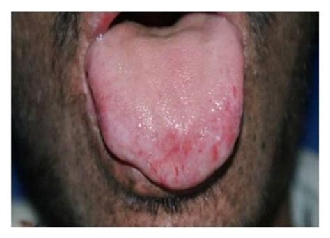 Precancerous Lesion Affecting The Tip Of The Tongue Download