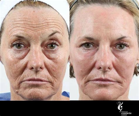 Non Surgical Skin Tightening And Skin Lifting With Minimal Downtime