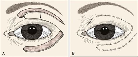 17 Reconstruction Of The Eyelids Pocket Dentistry