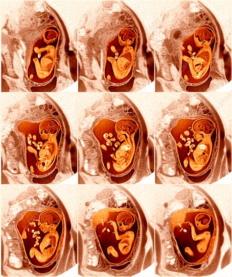 9 Month Foetus MRI Scans Stock Image P680 0678