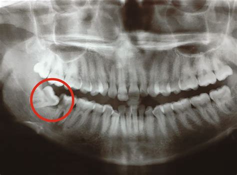 Problems With Erupting Wisdom Teeth Signs Symptoms And Management