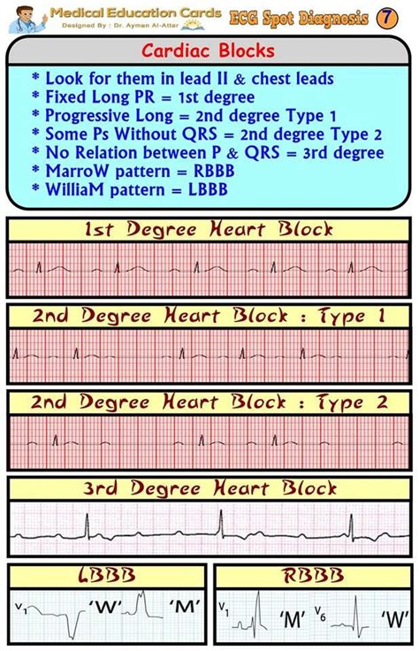Chart Of Heart Rhythms
