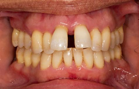 Gum Disease Gallions Reach Dental Clinic