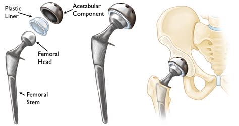 Revision Total Hip Replacement Orthoinfo Aaos