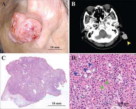 John Libbey Eurotext European Journal Of Dermatology A Case Of