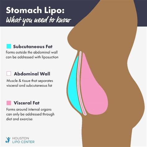 Can You Get A Flat Stomach With Liposuction Houston Lipo Center