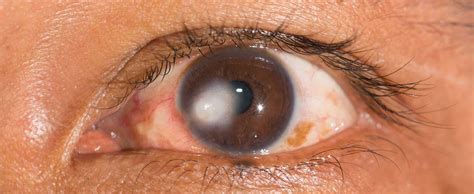 Ayurvedic Treatment For Corneal Scar Corneal Scar Ka Ilaj