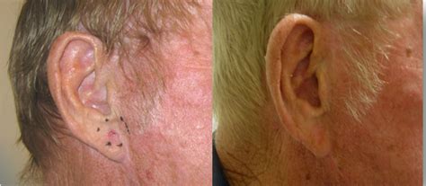 Ars Clinical Melanoma Skin Moles Skin Cancer Carcinoma Basal