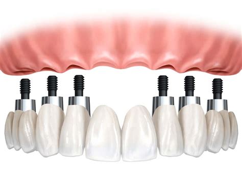 Sobre Dentadura Sobre Implantes Clínica Dental Revert Dentista Puerto De Sagunto