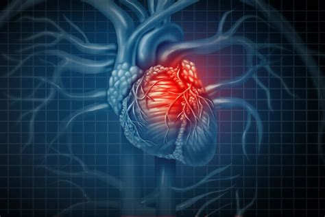Ataque Al Corazón Causas Síntomas Signos Y Tratamientos Saludaio