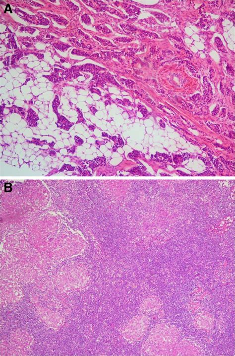 Case Report Breast Cancer Associated With Contralateral Tuberculosis