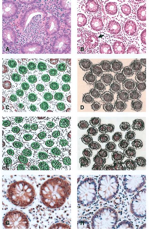 A Ulcerative Colitis A Typical Crypt Abscess With Dense Inflammatory