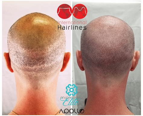 Scalp Micropigmentation For Scar Camouflaging International Hairlines
