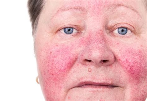 Rosacea On Chest