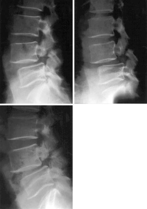A Preoperative Lateral Radiograph Of A 49 Year Old Patient With